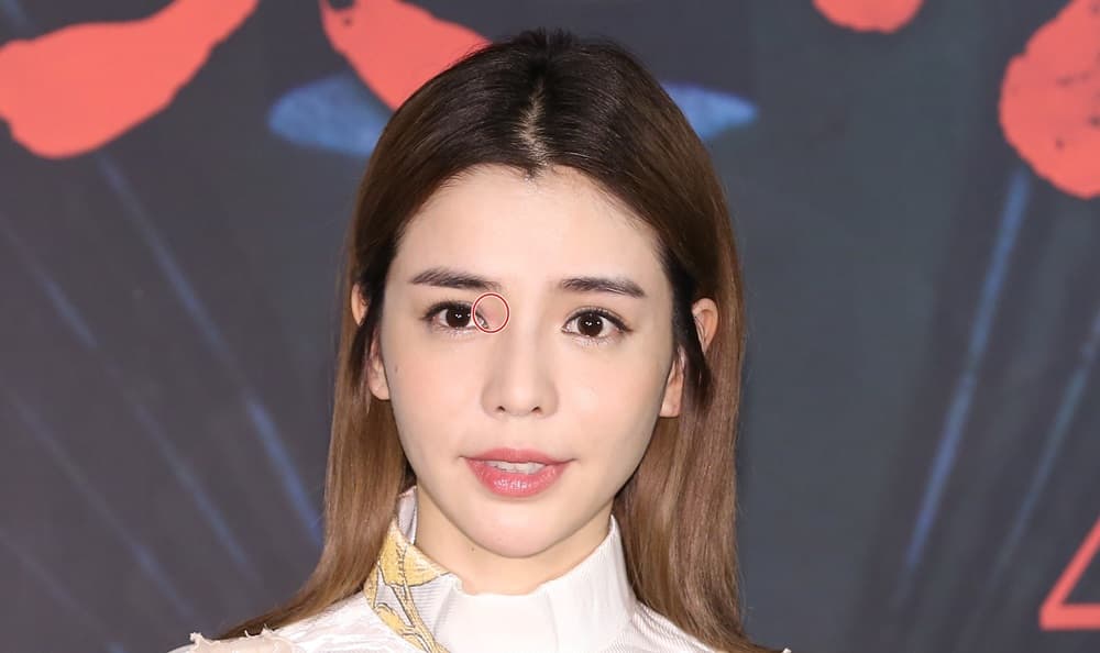 李毓芬突然眼睛過敏,發生泛紅現象(紅圈處)。