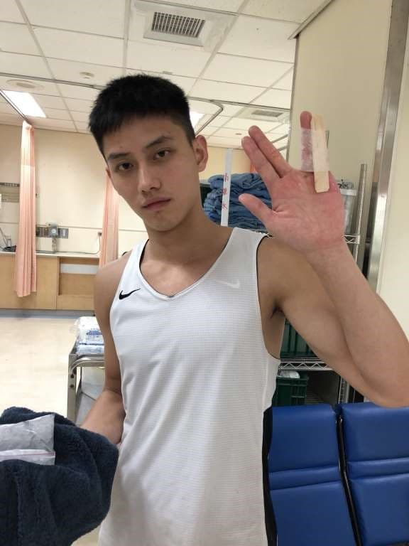 范少勳拍片時左手小拇指因碰撞脫臼變形。(范少勳提供)