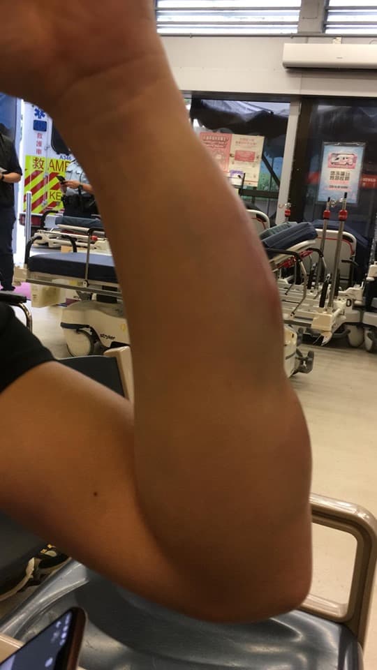 民陣召集人及其友人遭蒙面人持棒球棍和長刀攻擊,友人挨打手腫到不行。(翻攝民間人權陣線臉書)