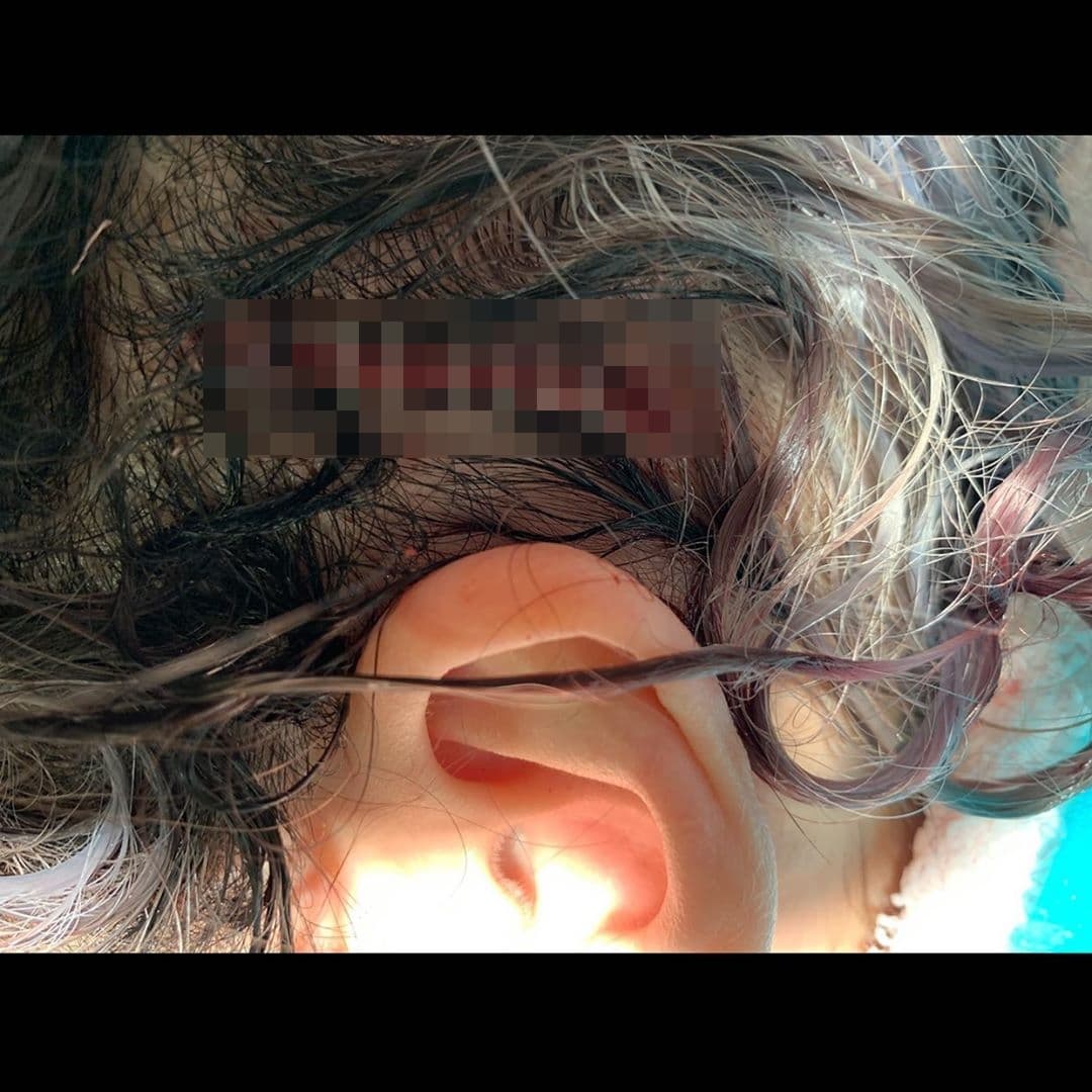 蕭亞軒的傷口很深,令人怵目驚心。(翻攝自蕭亞軒IG)