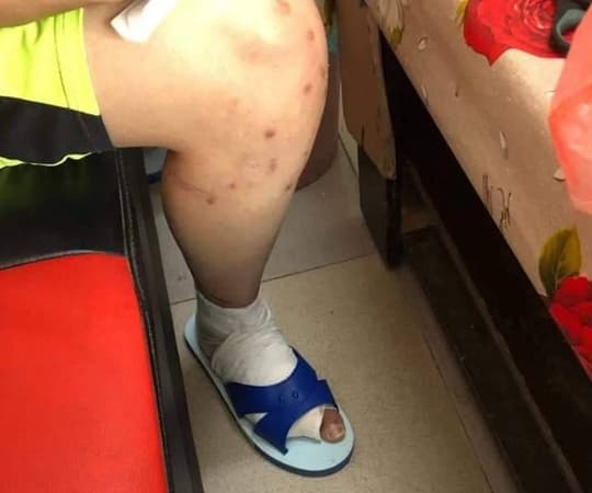 少年透露,自己在長期遭受電擊、痛毆的攻擊下,右腳已有3隻腳趾壞死。(翻攝彰化踢爆網)