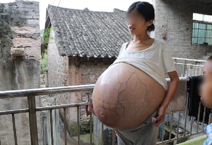 婦人搭公車時還被懷疑是否懷「多胞胎」,讓她難以解釋。(翻攝光明網)