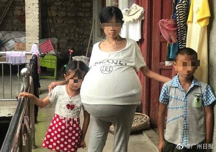 育有兒女的婦人生活相當困苦,醫療費用對她來說相當沉重。(翻攝光明網)