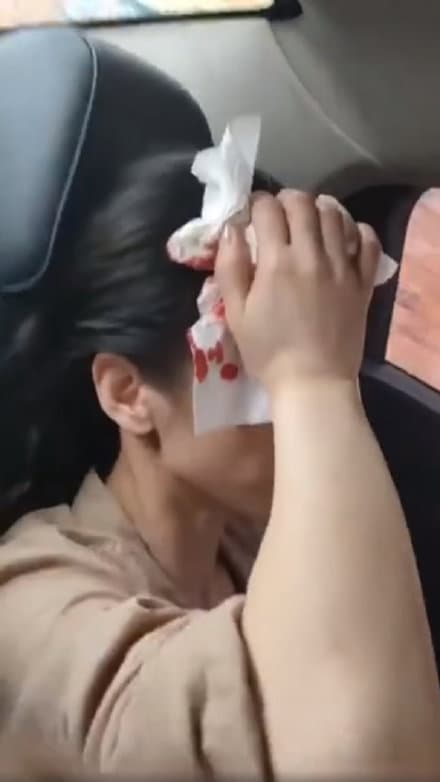 黃聖依也在拍戲時遭道具砸傷頭,按在傷口上的衛生紙點點血跡十分驚悚。(翻攝自黃聖依粉絲團微博)