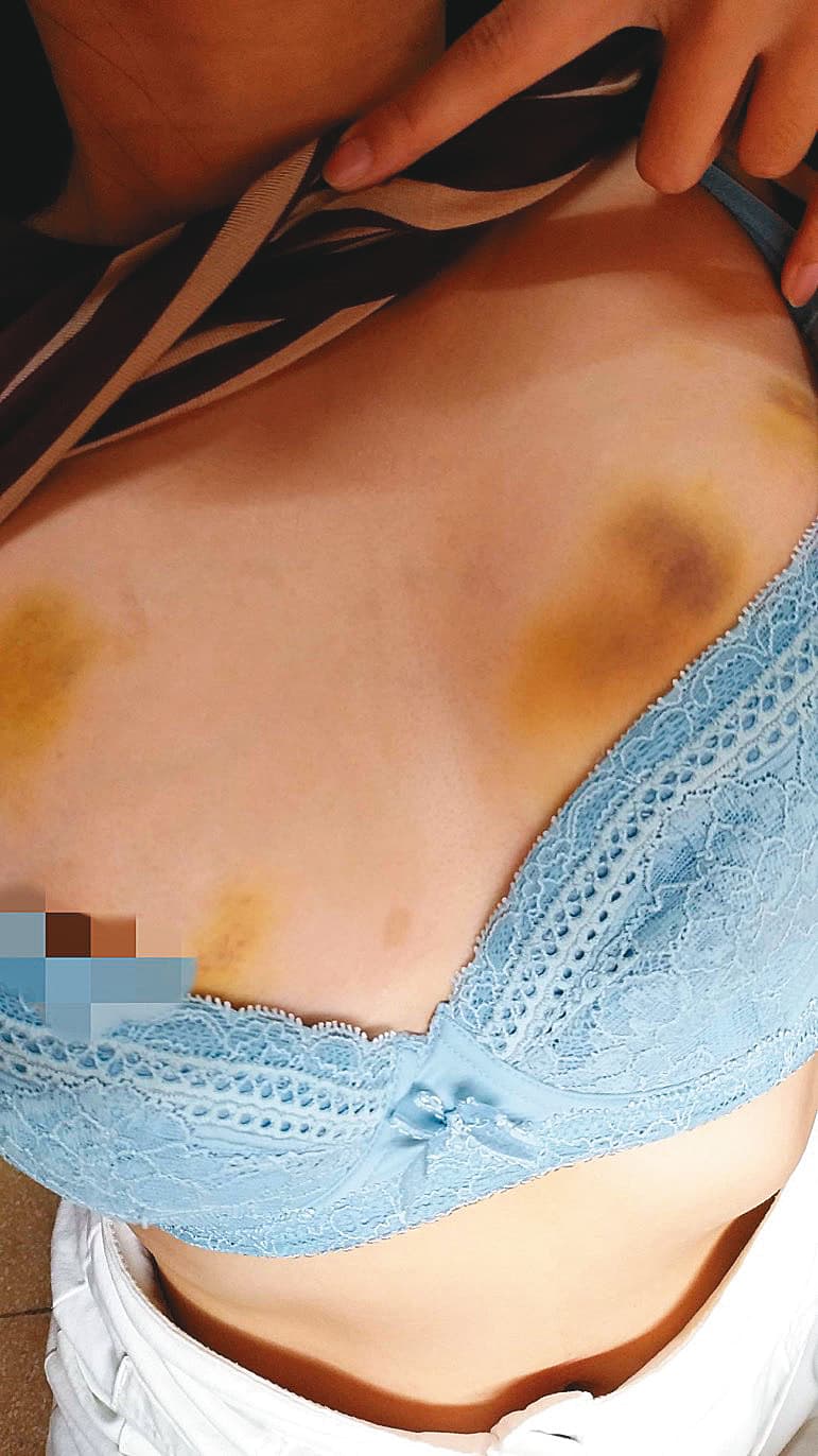 謝男前女友小玉控訴,謝男只要動怒,就會動手打人,她胸前的一片瘀青,就是謝男施暴的結果。(讀者提供)
