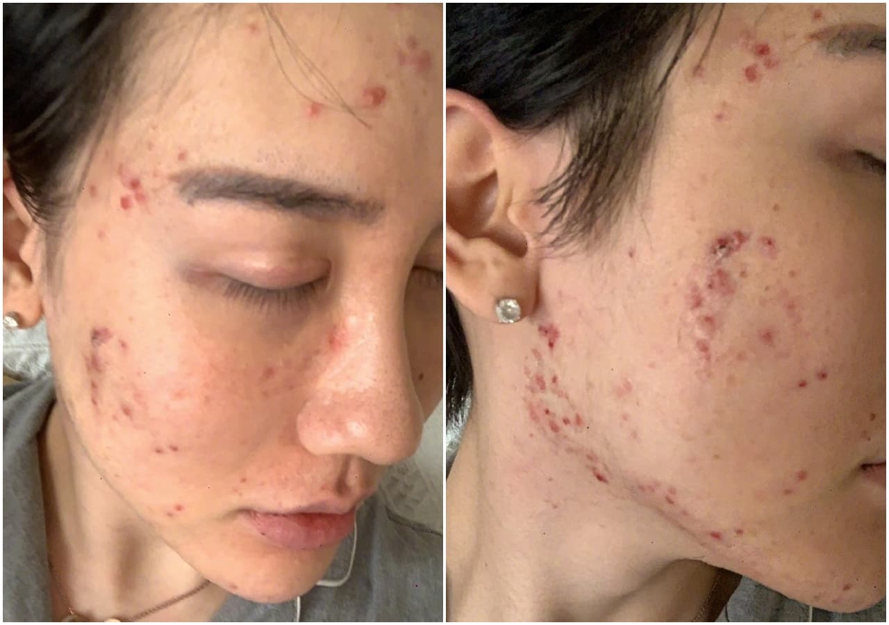 劉梓晨上傳全臉潰爛照，引發網友熱議。（翻攝自劉梓晨微博）