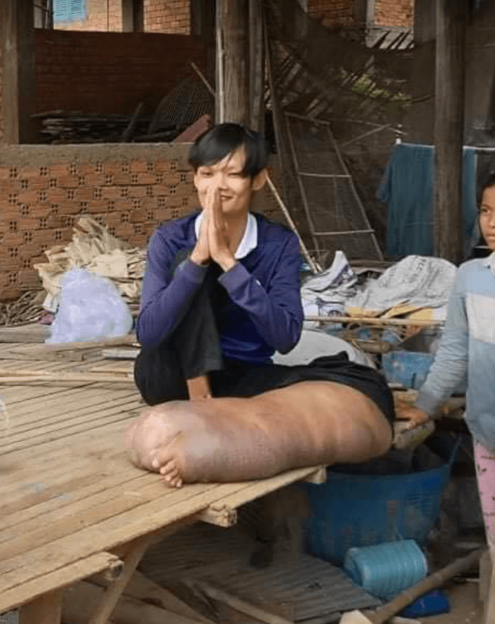 邦特的腳腫脹成一般人5倍大小,造成生活嚴重不便。(圖源:ទ្រី ដាណា Dana Try臉書)