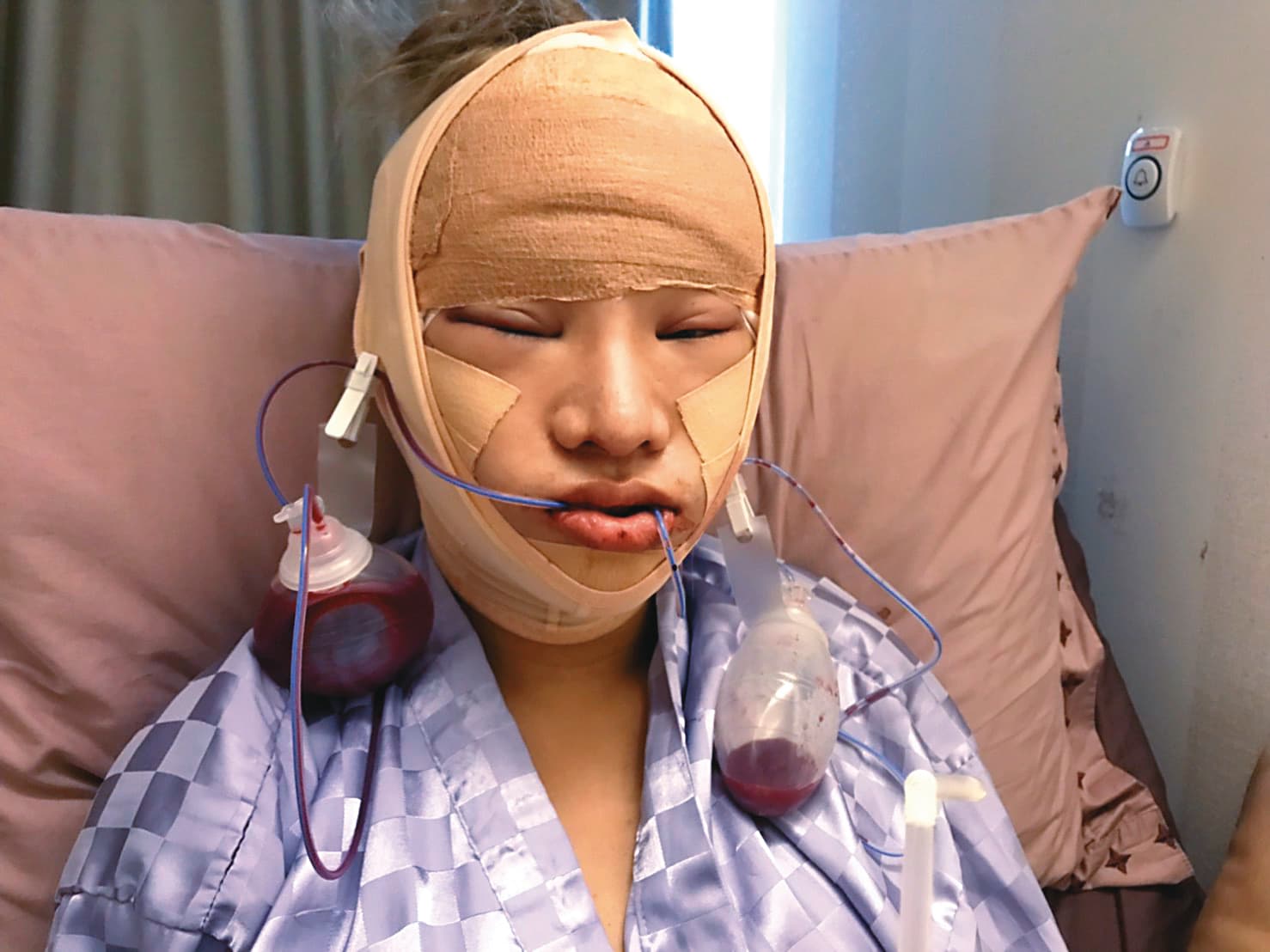 為了讓臉部的輪廓更接近女性,小A辣不惜削骨、掀頭皮。(小A辣提供)