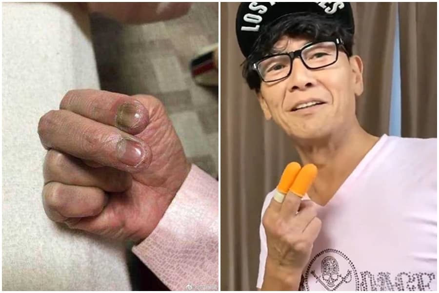 加藤鷹食指、中指竟出現潰爛,指甲甚至還呈灰色。(翻攝自YouTube/加藤鷹推特)