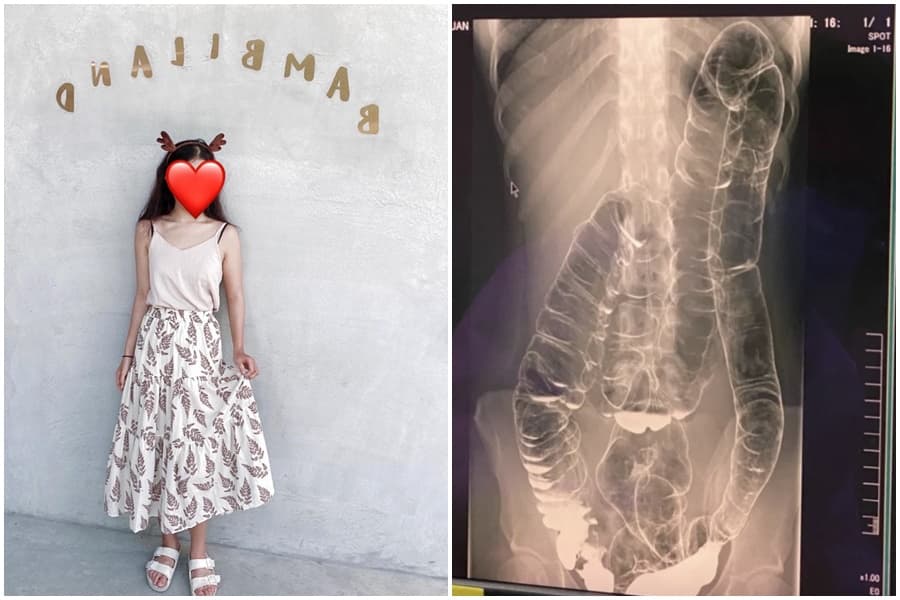 女網友在Dcard透露從小受便祕所苦,照了X光才驚覺大腸竟已擠壓到接近胸腔位置。(翻攝自Dcard、當事人授權)
