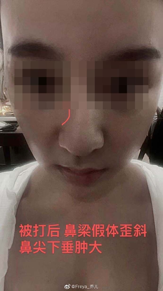 女子表示自己動過刀的鼻樑被打歪，鼻尖下垂腫大。（翻攝自微博）