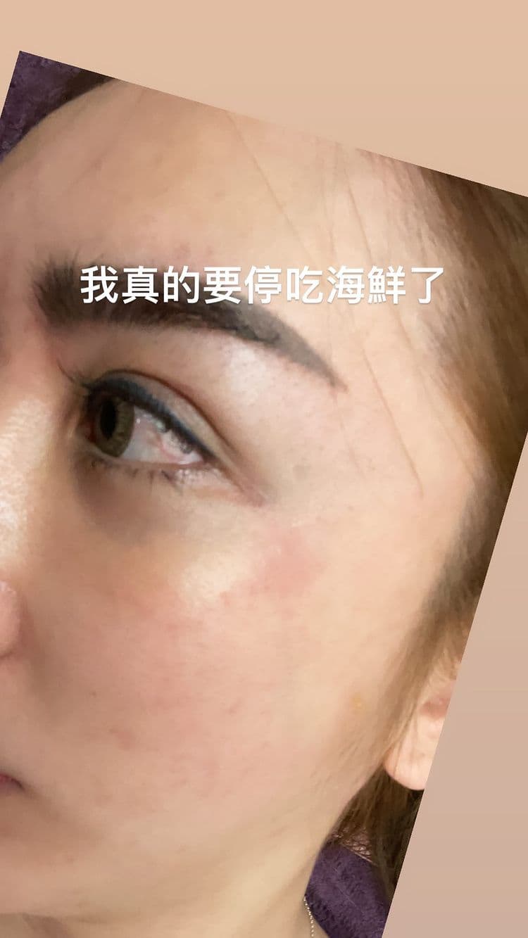 由於罔腰最近愛吃蝦子,疑似因此造成過敏,讓她覺得該忌口一下了。(翻攝自罔腰IG)