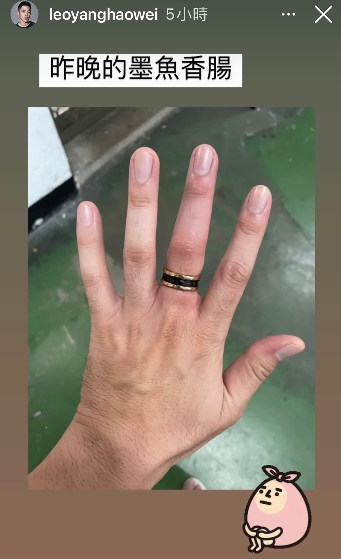 楊皓崴中指因戒指卡住血液循環不良發黑,宛如墨魚香腸。(翻攝自楊皓崴IG)