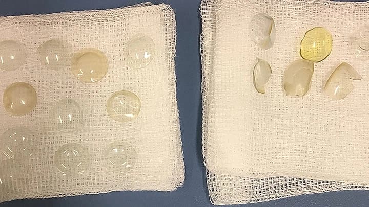 從阿嬤眼睛中取出大量隱形眼鏡後,連執業多年的醫生都相當驚訝。(翻攝自《Optometry Today》)