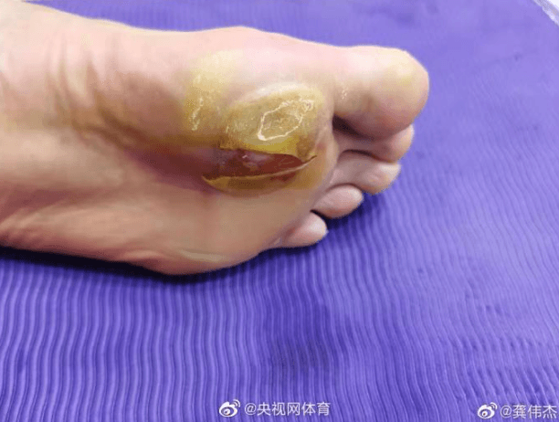 諶龍腳底起了個大水泡,傷口還破掉見肉了。(翻攝微博)