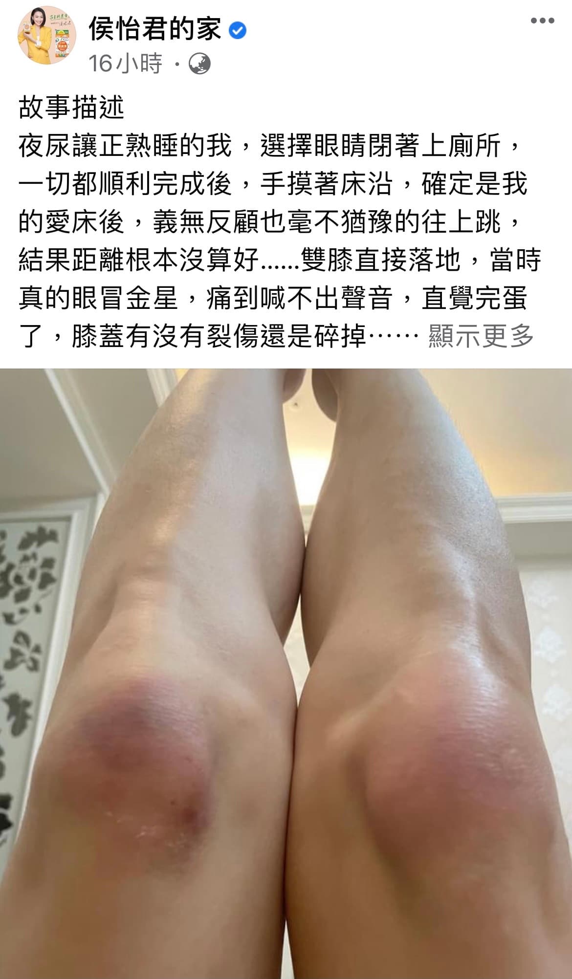 侯怡君貼出自己雙膝瘀青照片,讓人不忍直視。(翻攝自侯怡君臉書)