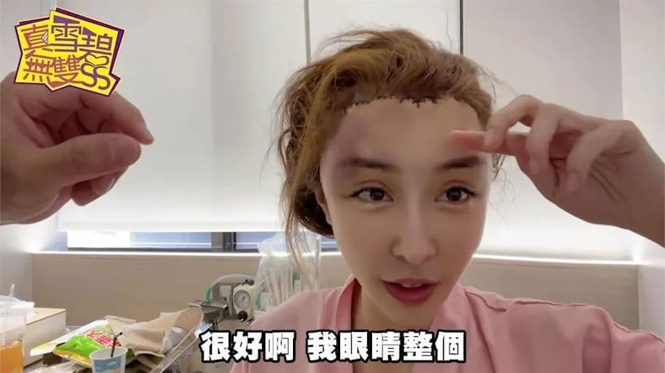 雪碧在「驚悚掀頭皮整形額頭實境」片分享自己手術前後過程。（翻攝「赤裸裸的教主雪碧」YouTube）