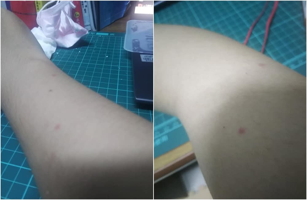 原PO和泰國妹連結後,手上出現多顆不明紅斑。(翻攝臉書「爆廢公社」)
