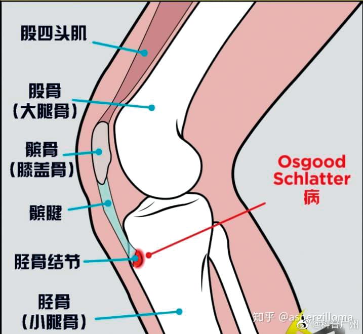 「奧斯古—謝拉德症」是跑跳運動時,脛骨結節被髕骨肌腱拉扯導致發炎。(翻攝自科普廣州微博)