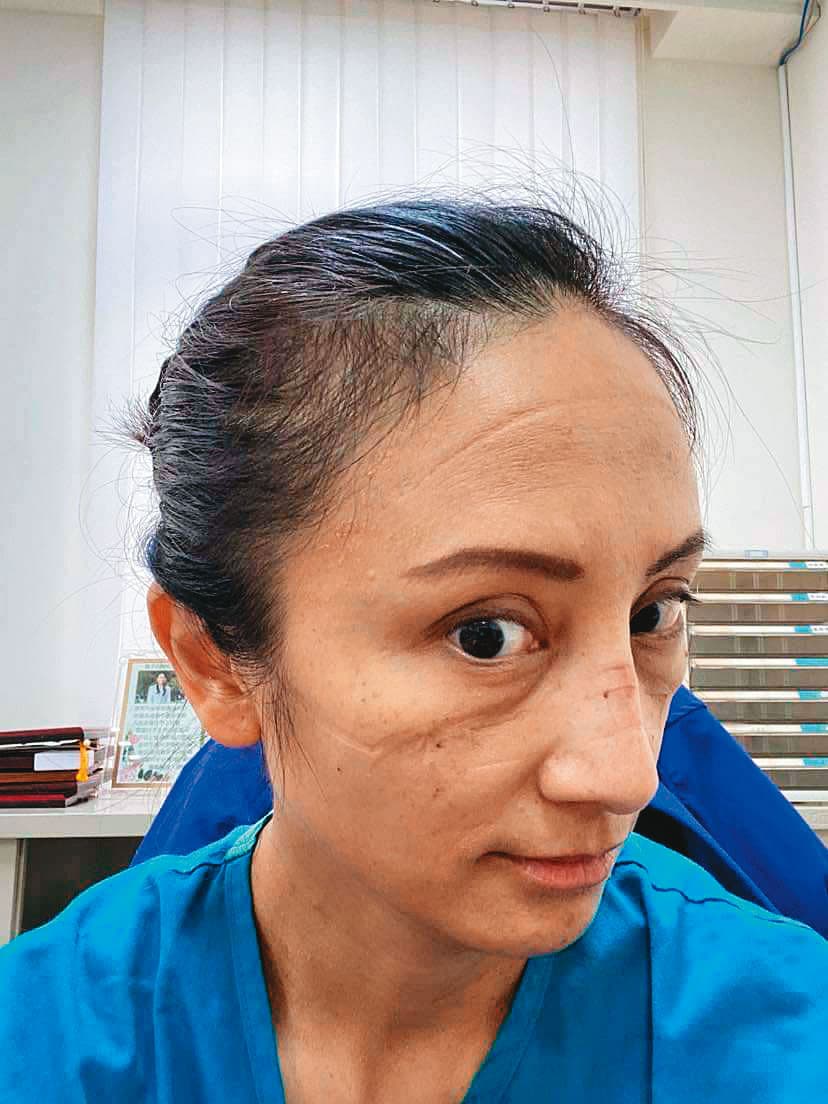 田知學醫師曾上傳值班後臉上清晰的口罩勒痕和脫皮照片,獲得上萬點讚感謝 。(田知學提供)