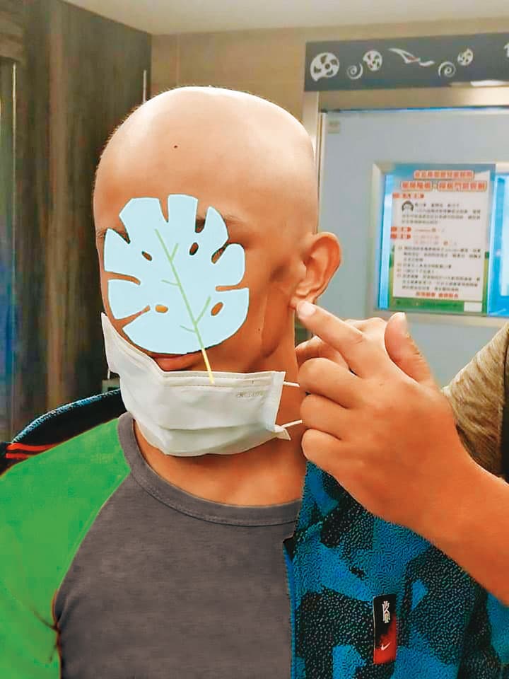 許姓少年動過2次削臉手術,左臉明顯出現凹陷。(讀者提供,少年已變裝處理)