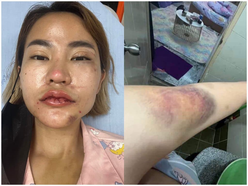 娃娃慘遭男友家爆。(翻攝自娃娃臉書)