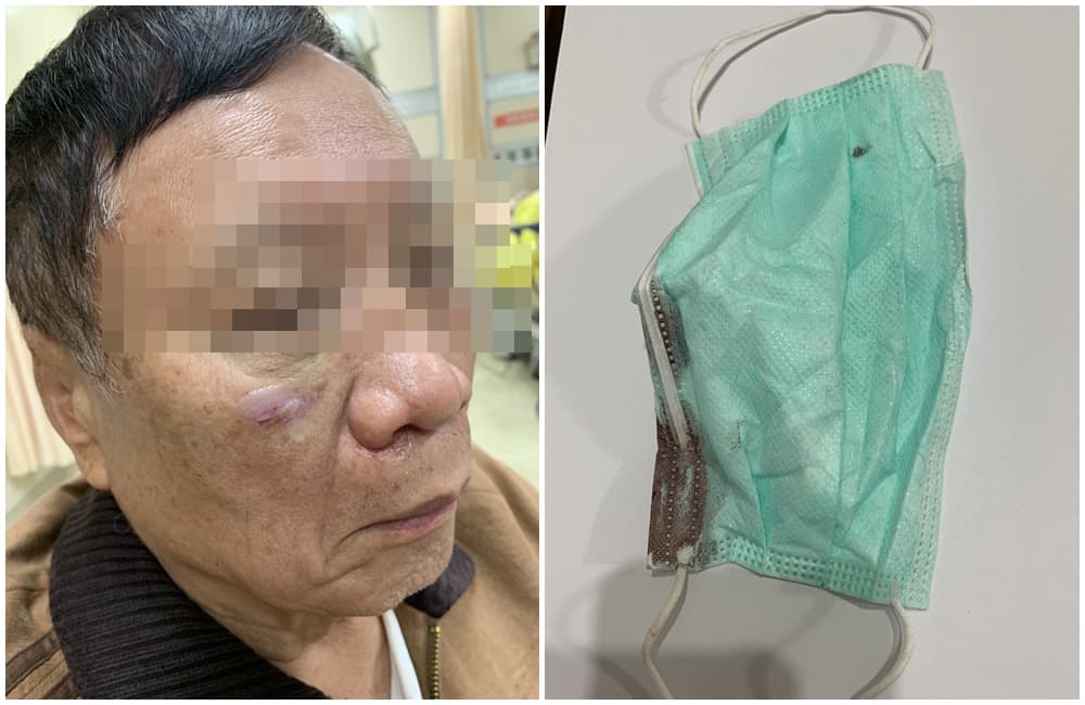 楊姓董座當時被強押拘禁毆打，臉部多處明顯傷勢，獲釋時口罩還留有血跡。（讀者提供）