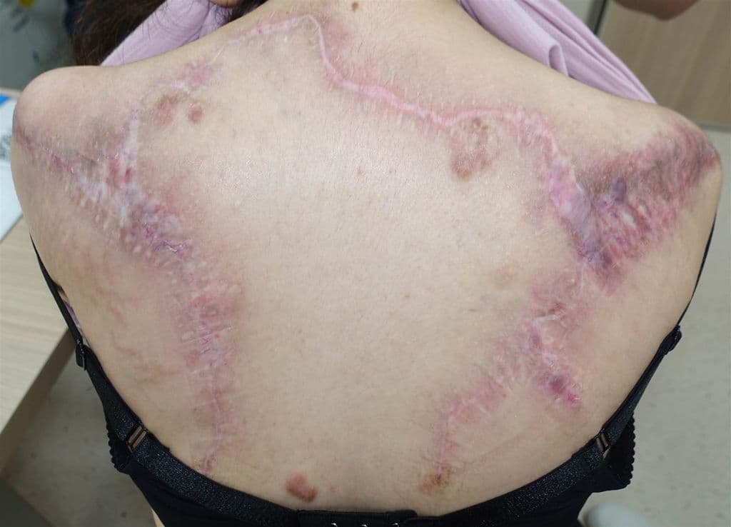 陳小姐背部嚴重蟹足腫經手術及放射治療後大幅改善。(基隆長庚醫院提供)