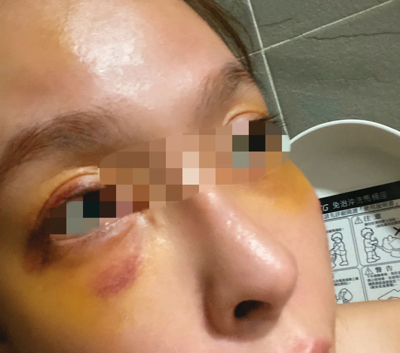 娃娃7月遭前男友施暴,當時她雙眼瘀青腫脹。(娃娃提供)