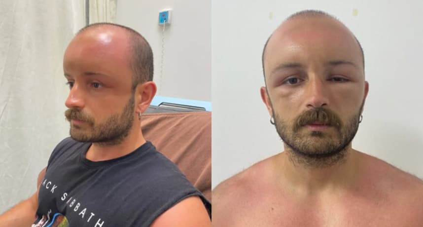 經檢查發現,男子面部腫脹是「熱水腫」引起,研判可能是因為戴了阻礙血液循環的帽子導致。(圖片翻攝自ladbible)