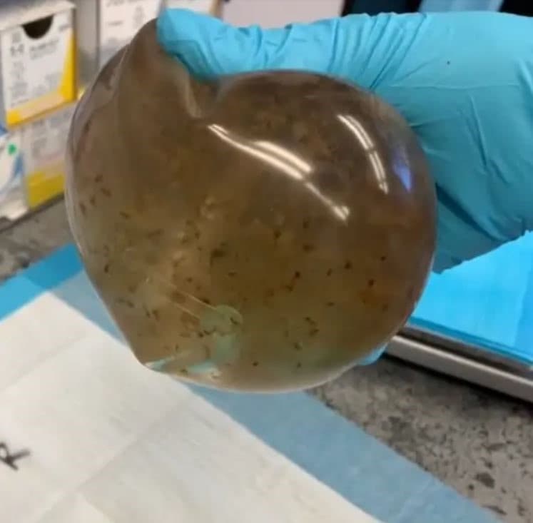 梅麗莎呼籲大家要注意隆乳所帶來的危險與後遺症。（翻攝IG melisssssalima）