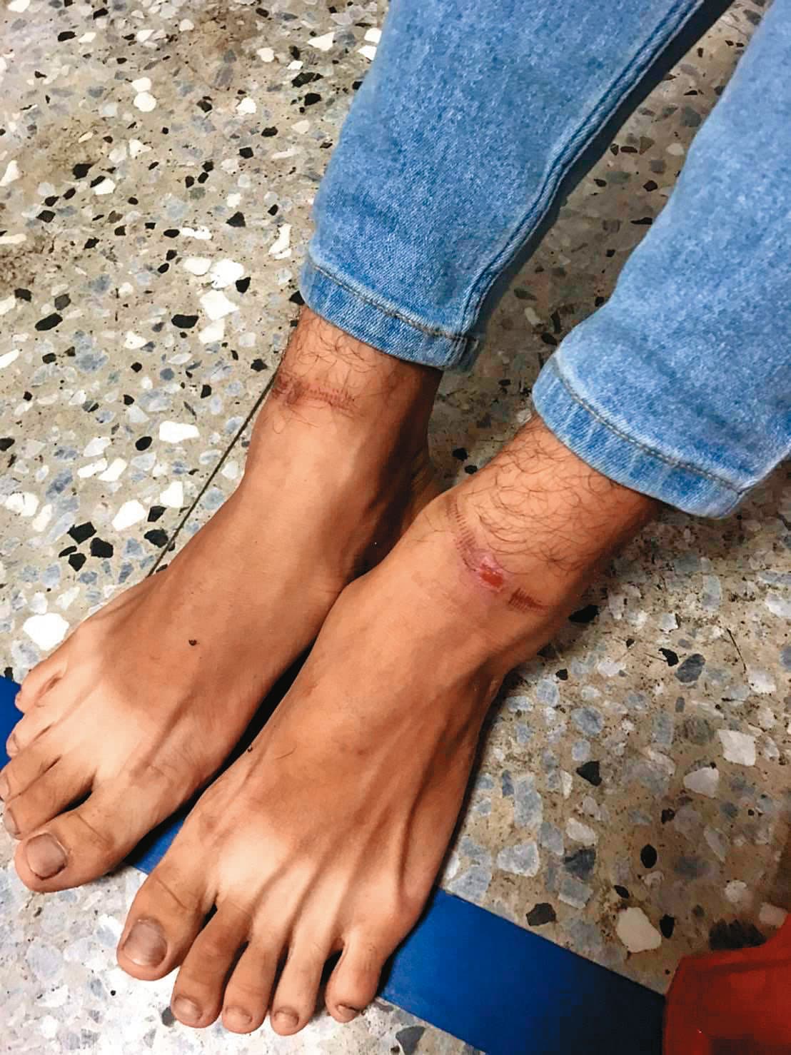 受害者連雙腳也被上銬，留下明顯傷痕。（警方提供）