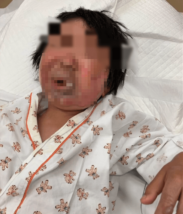 男童被點火秀冒出的火焰灼傷,臉部被燒傷嚴重紅腫、部分水泡破皮。(翻攝推特@kamiccopu)