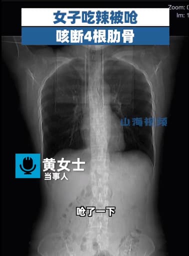 黃女咳嗽用力過猛,連呼吸都會痛,照X光片後顯示肋骨斷裂。(翻攝微博山海視頻)