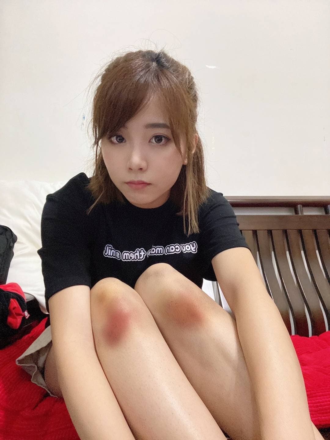 王上菲拍打戲滿腿都是瘀青。(經紀人提供)
