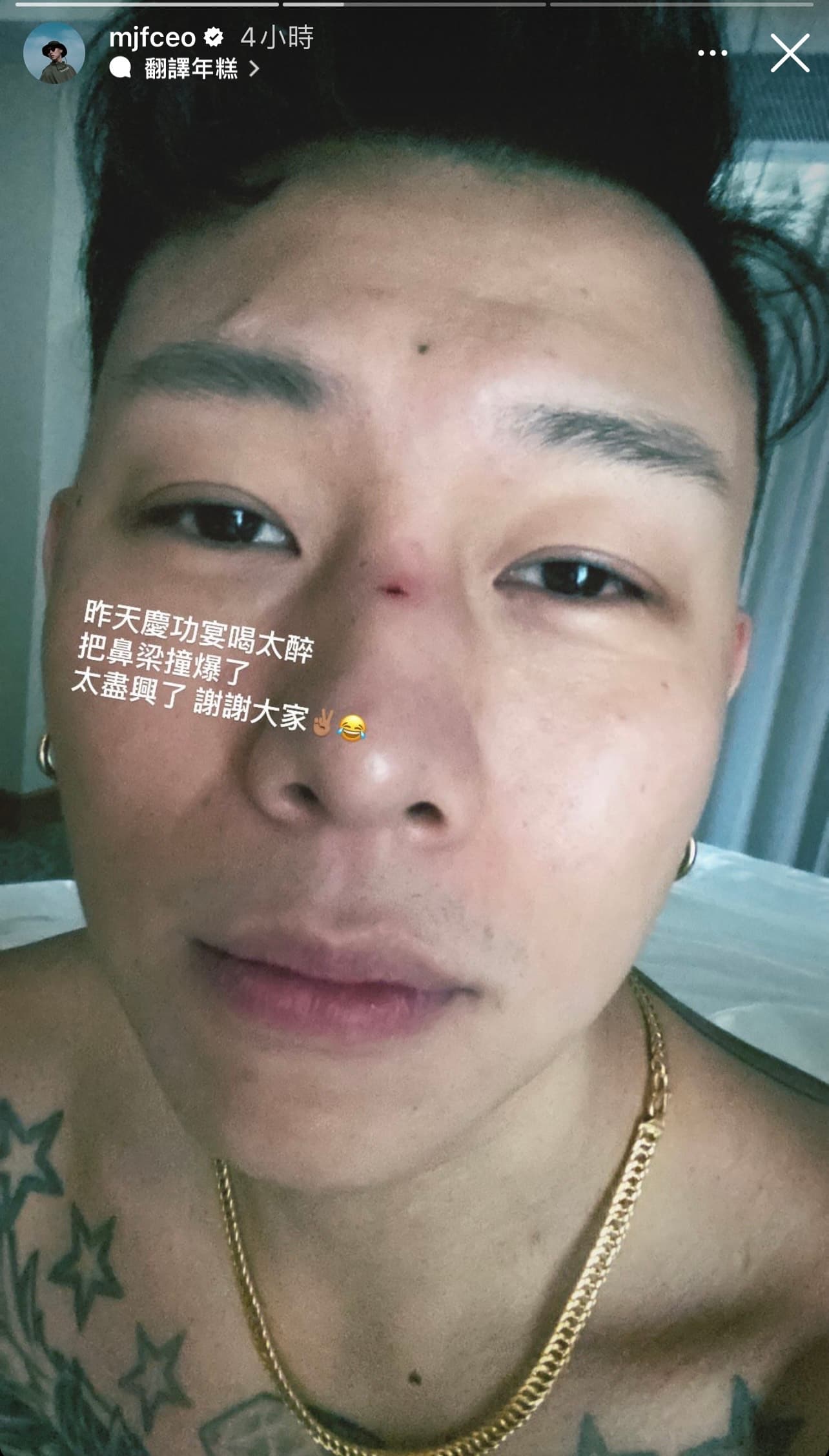 瘦子慶功喝太醉,撞傷破相。(翻攝自瘦子IG)