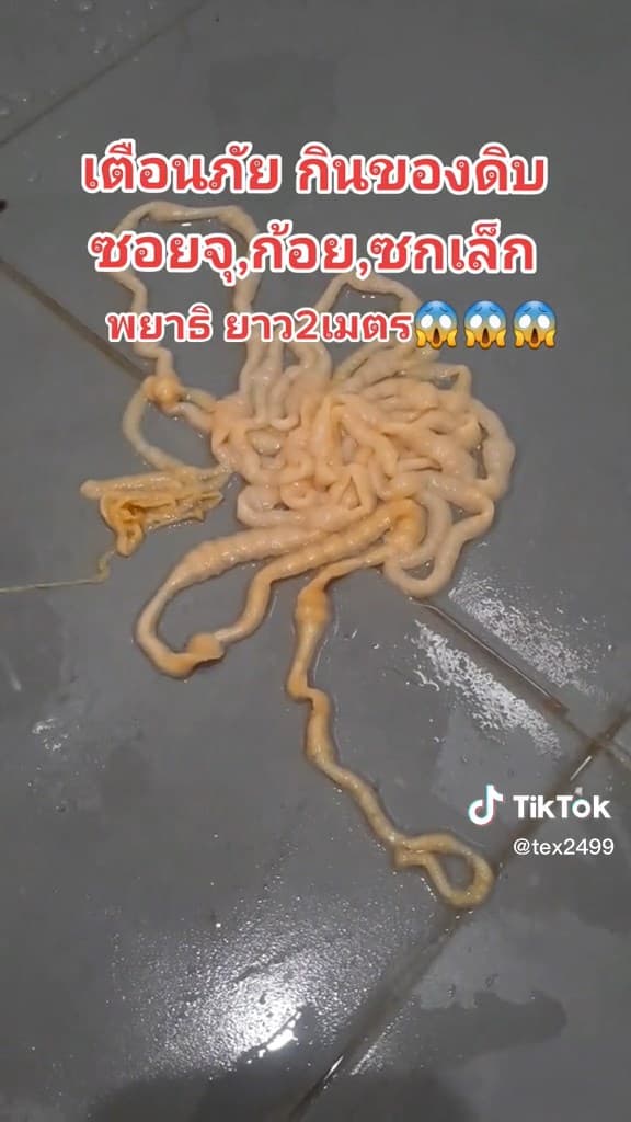 阿瑪力排出200公分寄生蟲。(翻自TikTok)