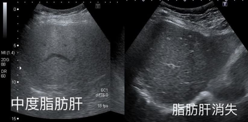 婦人在1年之內解決中度脂肪肝問題,連醫師都感到驚訝。(翻攝臉書粉專「錢政弘 胃腸肝膽科醫師」)