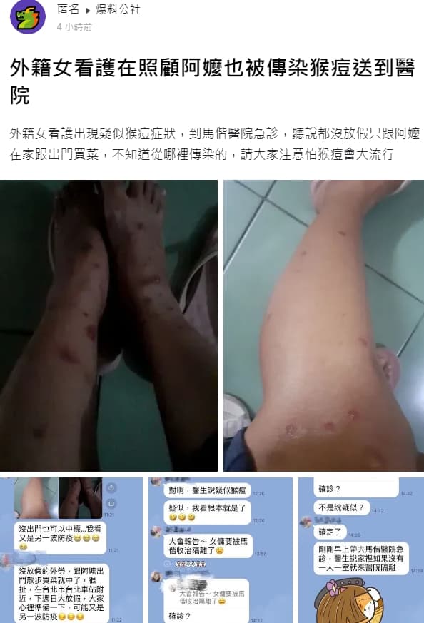 有網友在爆料公社發文,宣稱一名外籍女看護在照顧阿嬤期間感染猴痘。(翻攝自爆料公社)