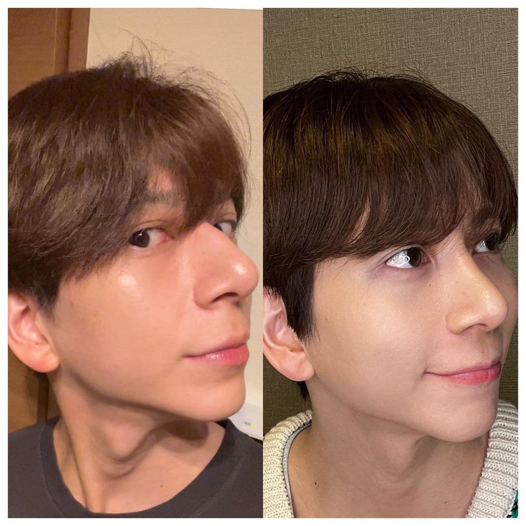 Kouhei曾大方在INS分享鼻子整型的對比圖。(翻攝Kouhei INS)