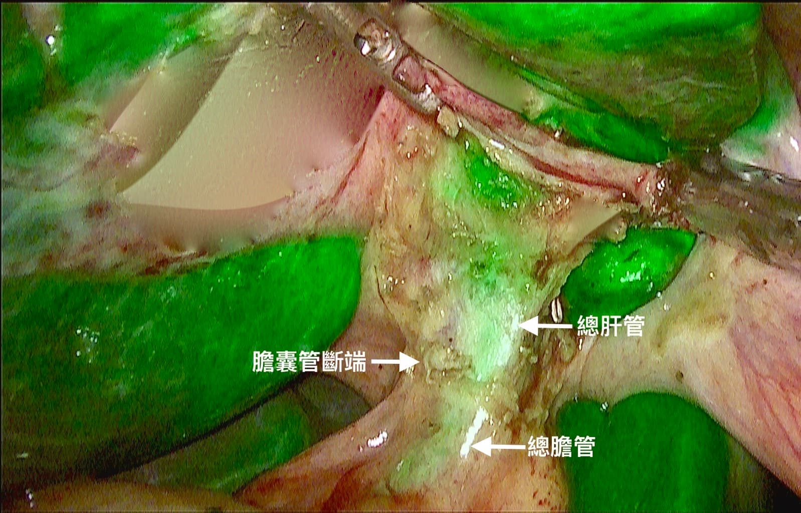 膽結石可透過腹腔鏡膽囊切除術處理。(中國醫藥大學新竹附設醫院提供)