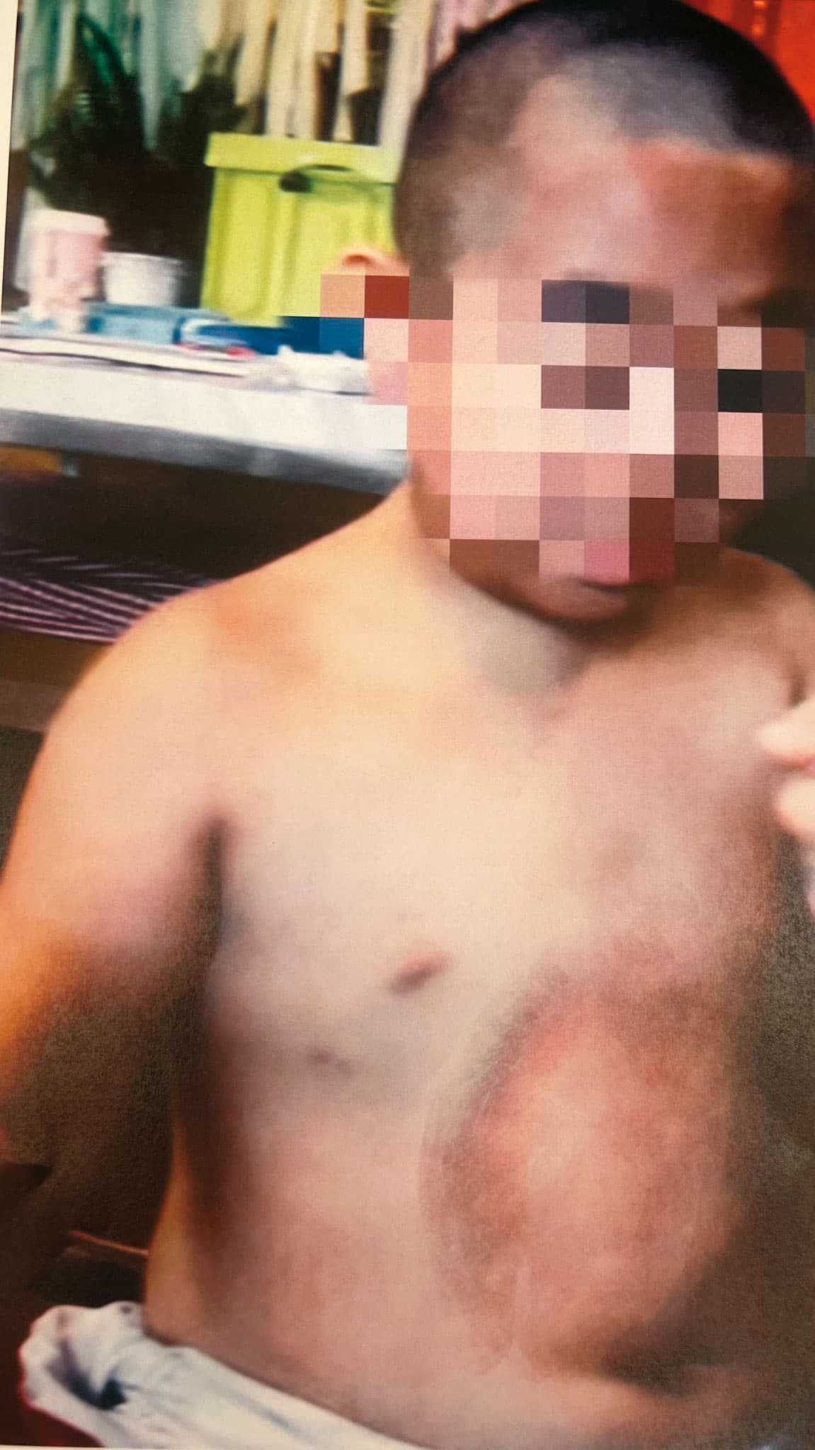 7歲男童小達(化名)遭快艇撞擊,頭、胸、腹部紅腫瘀傷。(讀者提供)