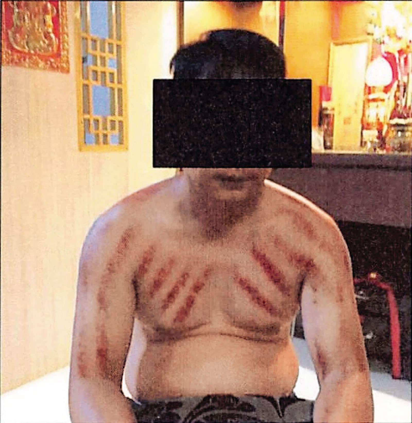 美方在起訴書指控陳志以各種暴力手段凌虐被害人,遭圈禁的「豬仔」傷痕累累。(翻攝《紐約郵報》)