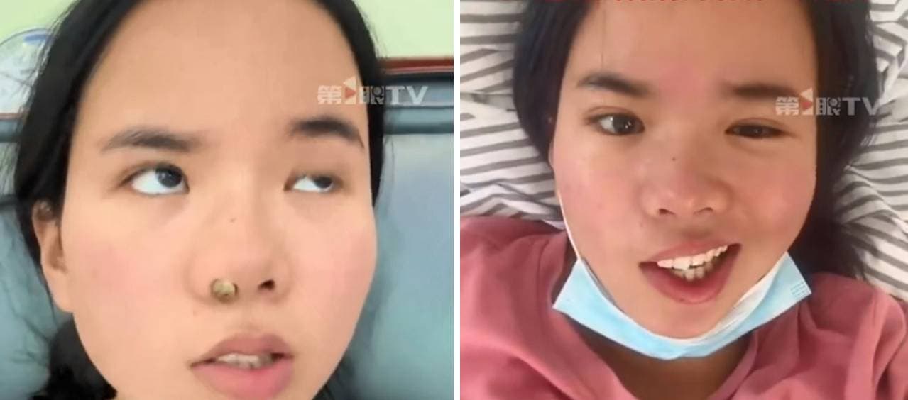 史女被診斷是「面癱」,嘴角經常無法控制,導致喝水、吃飯時經常漏出,讓她相當崩潰。(翻攝/微博)