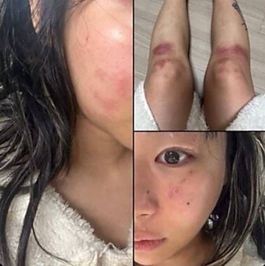 Jvcki Wai曬出被打得鼻青臉腫的照片。(網路圖片)