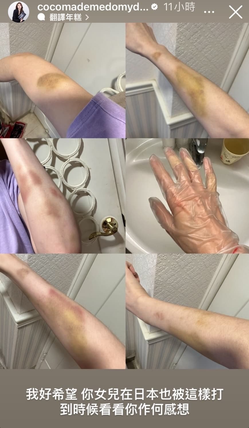林千又連發IG限動細數男友罪狀,公布自己滿身是傷的照片為證。(翻攝自林千又IG)