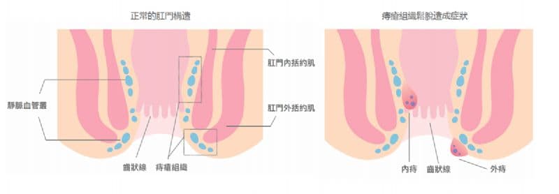 面對痔瘡問題,醫師提醒民眾無需過度羞恥或恐慌。(翻攝自衛福部網頁)