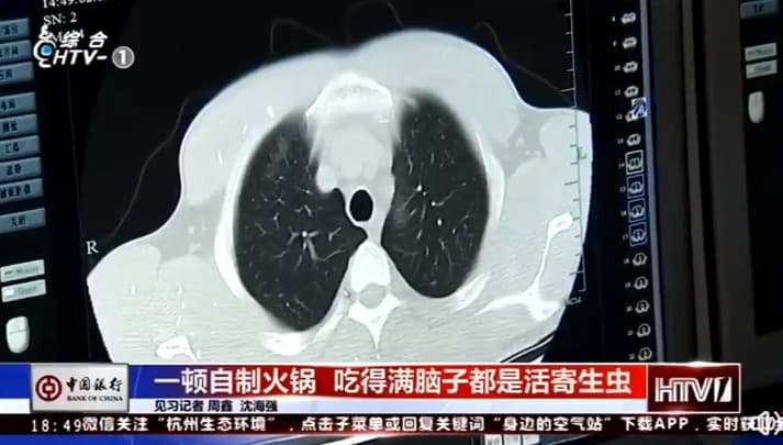 男子就醫經檢查,竟在腦中發現許多絛蟲。(翻攝微博)