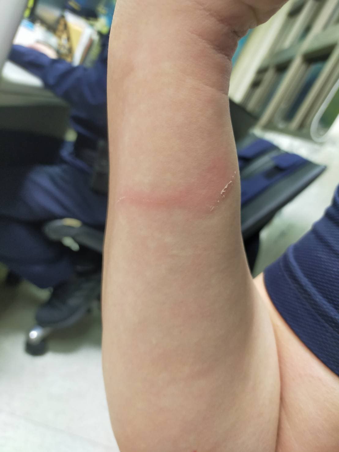 員警的手被毒蟲抓傷。(翻攝畫面)