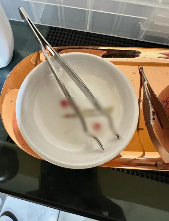 鳳梨自曝已移除2顆入珠,認為塞太滿導致癒合時會擠壓到。(翻攝threads@yi0107)